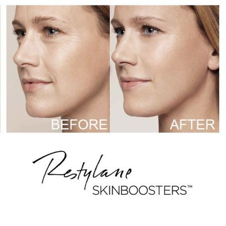 SKINBOOSTERS